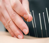 acupuntura-no-Cursino